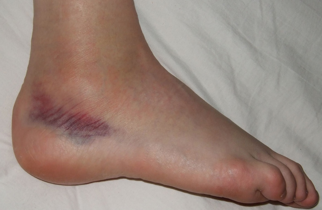 The Most Effective Ankle Ligament Surgery Procedure